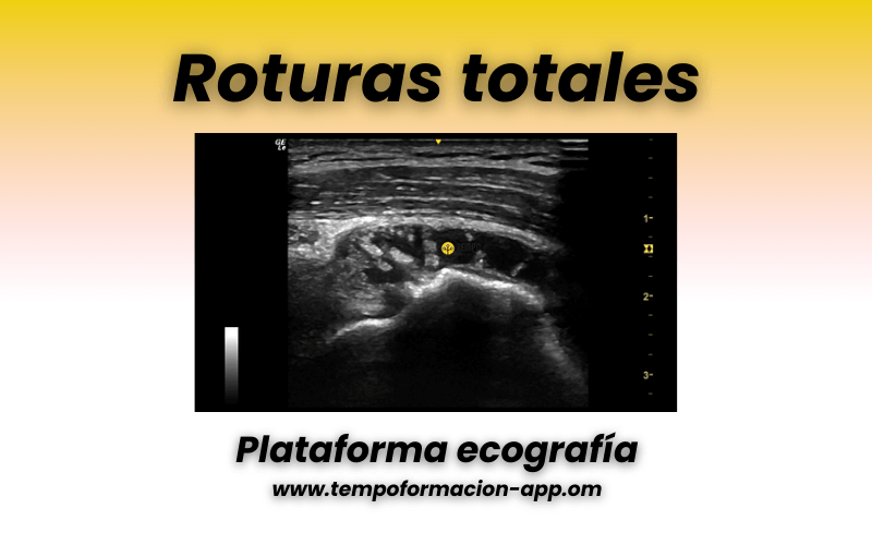 5. Tendon supraespinoso ecografia y patologia.png